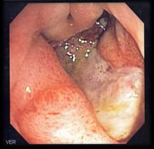 deep gastric ulcer